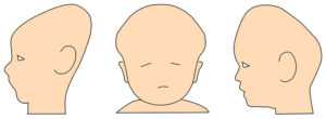 赤ちゃん　頭の形　変形