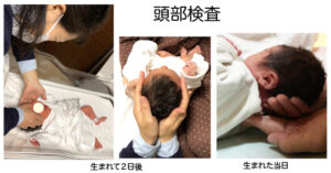 赤ちゃんの頭部の歪み検査