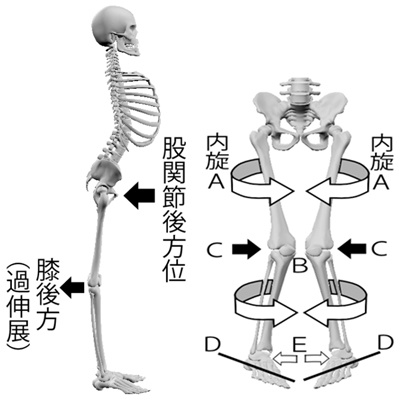 内股X脚、膝過伸展、反り腰のイラスト